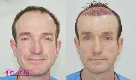 hair transplant internation patient
