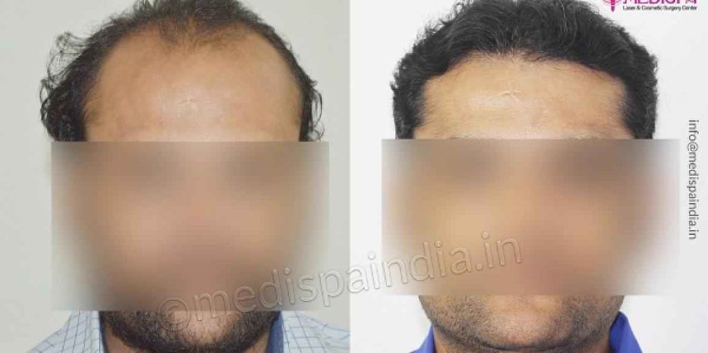 hair-transplant-results-india