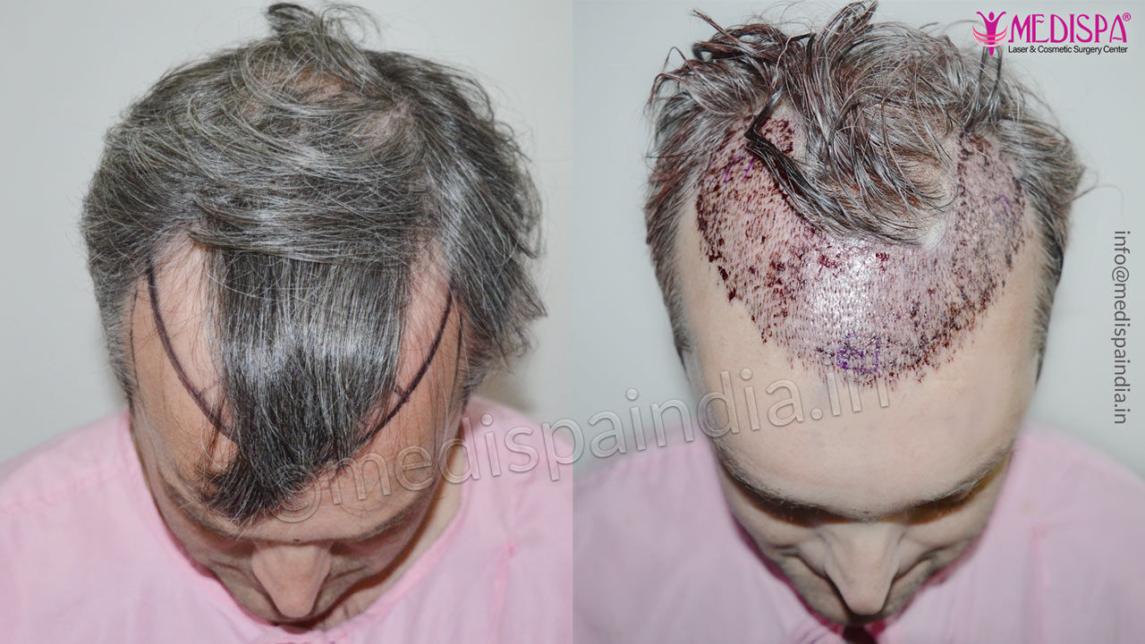 hair transplant results