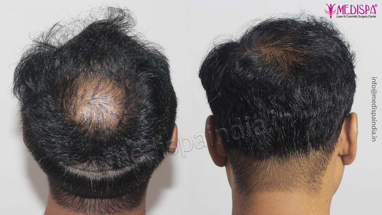 Hair Transplant Dubai results