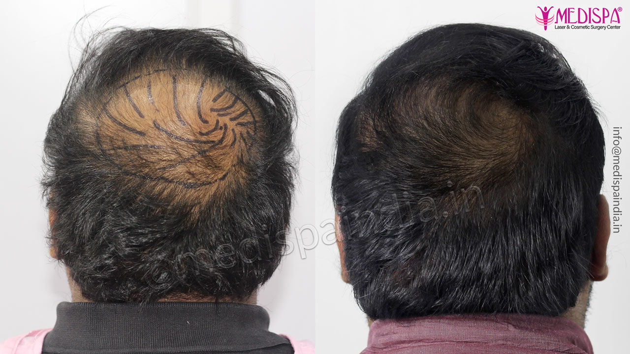 crown hair transplant india