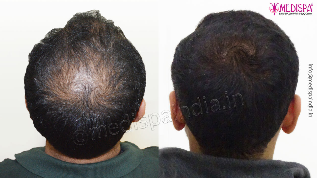 Hair Transplant Jaipur results