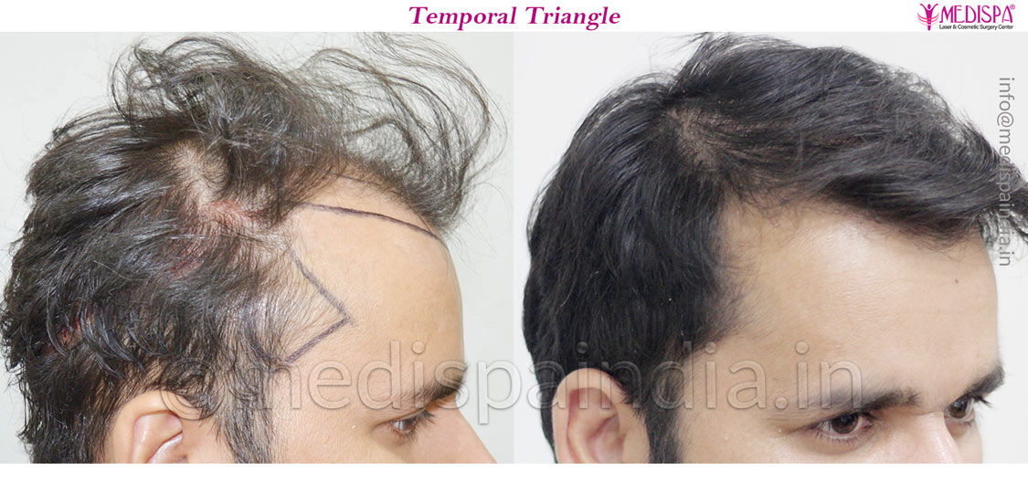 australia hair transplant cost