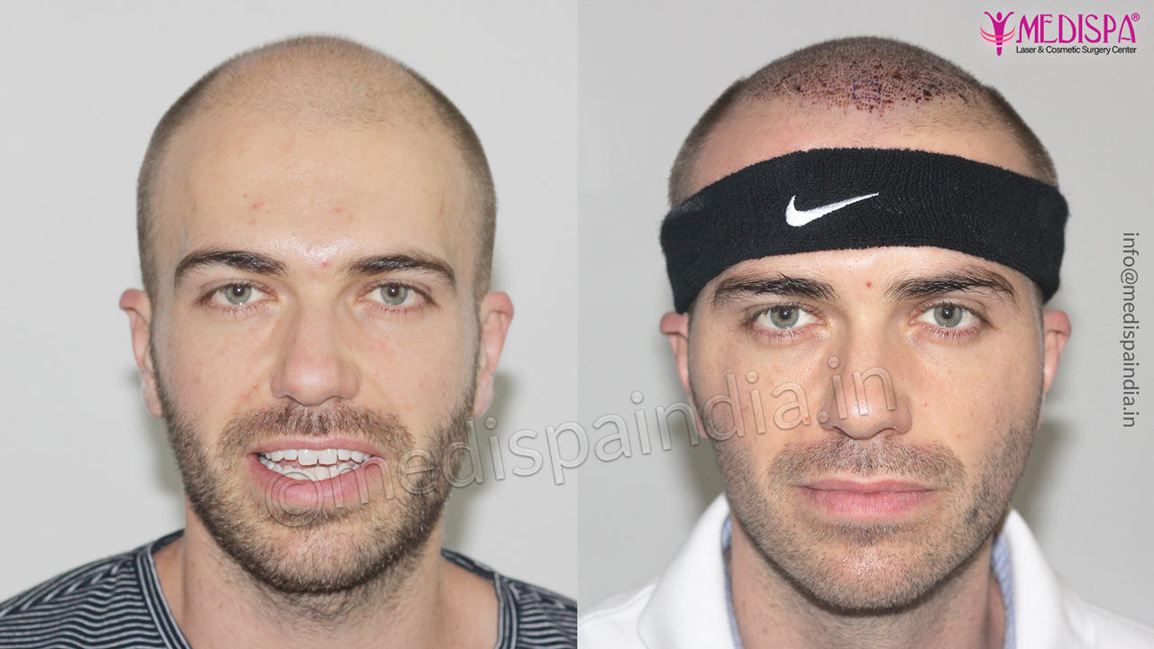 australian hair transplant results