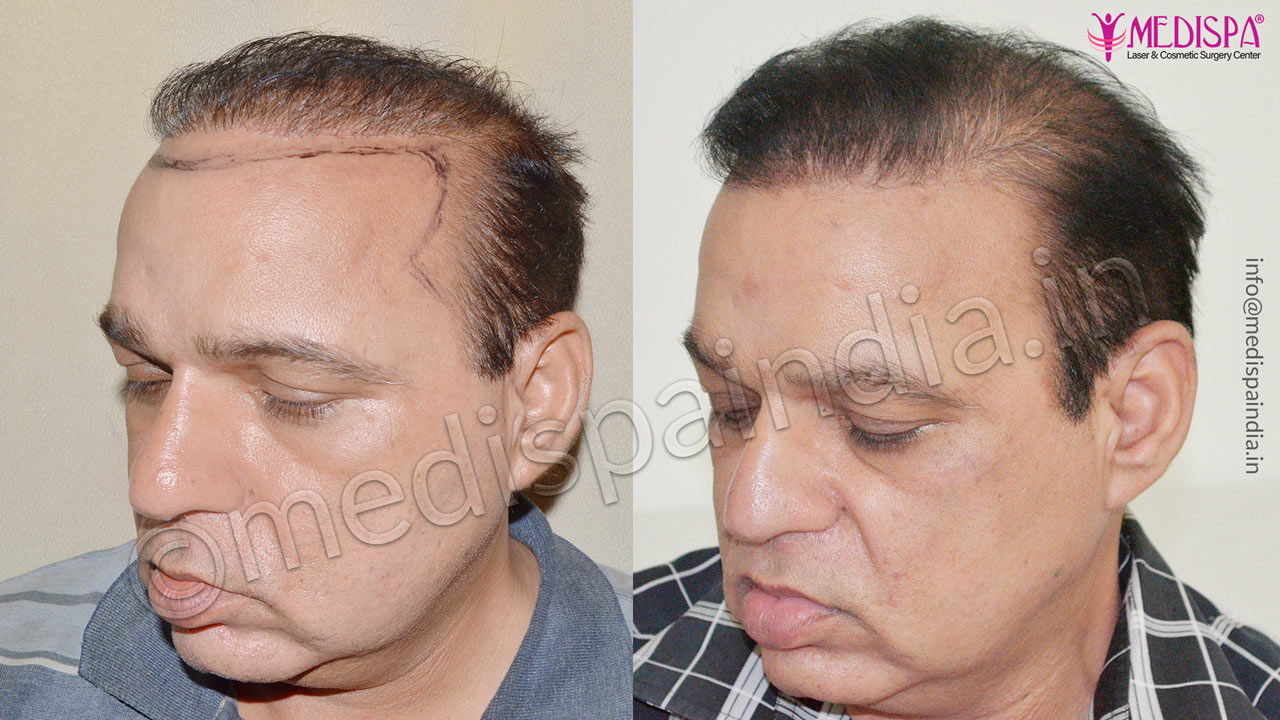 bad hair transplant repair delhi