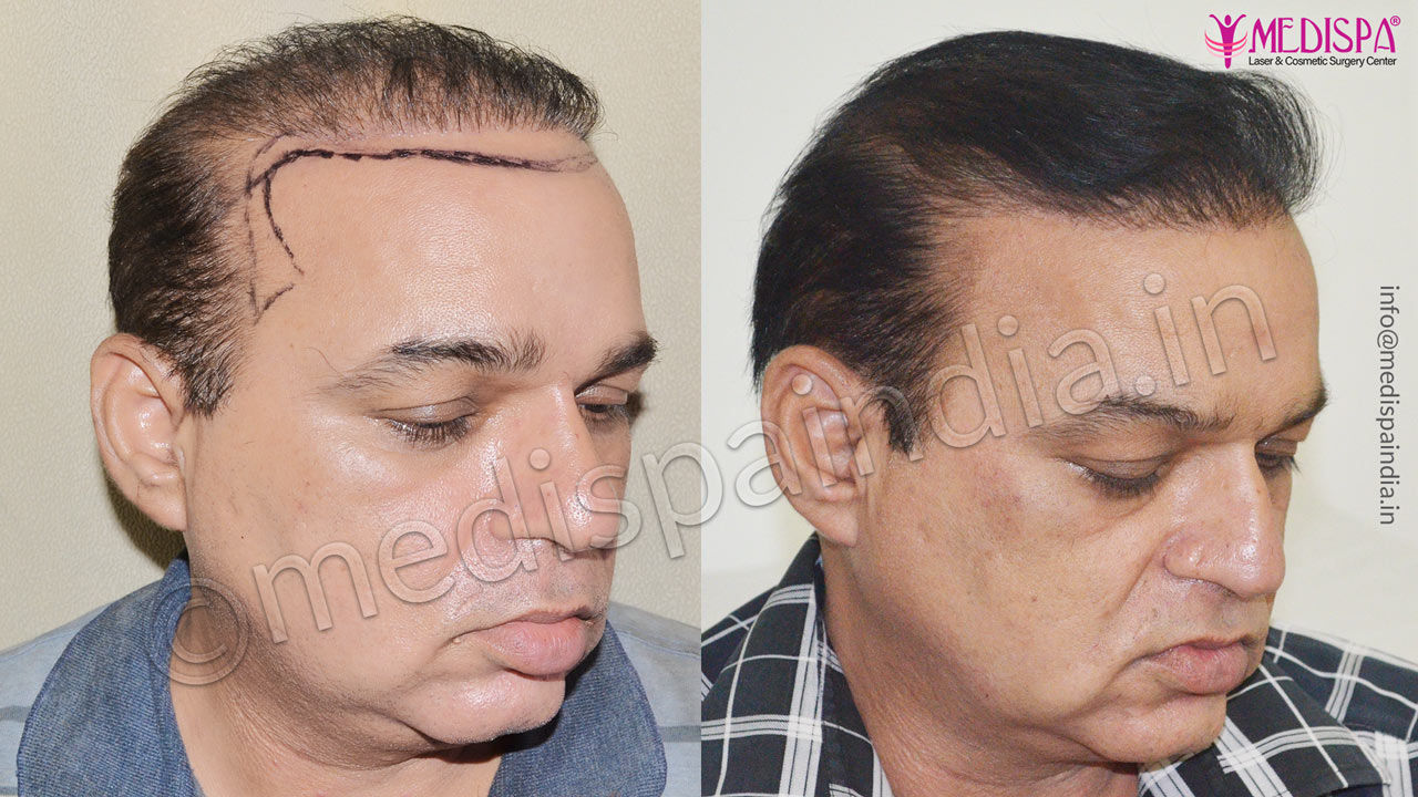 bad hair transplant repair jaipur rajasthan