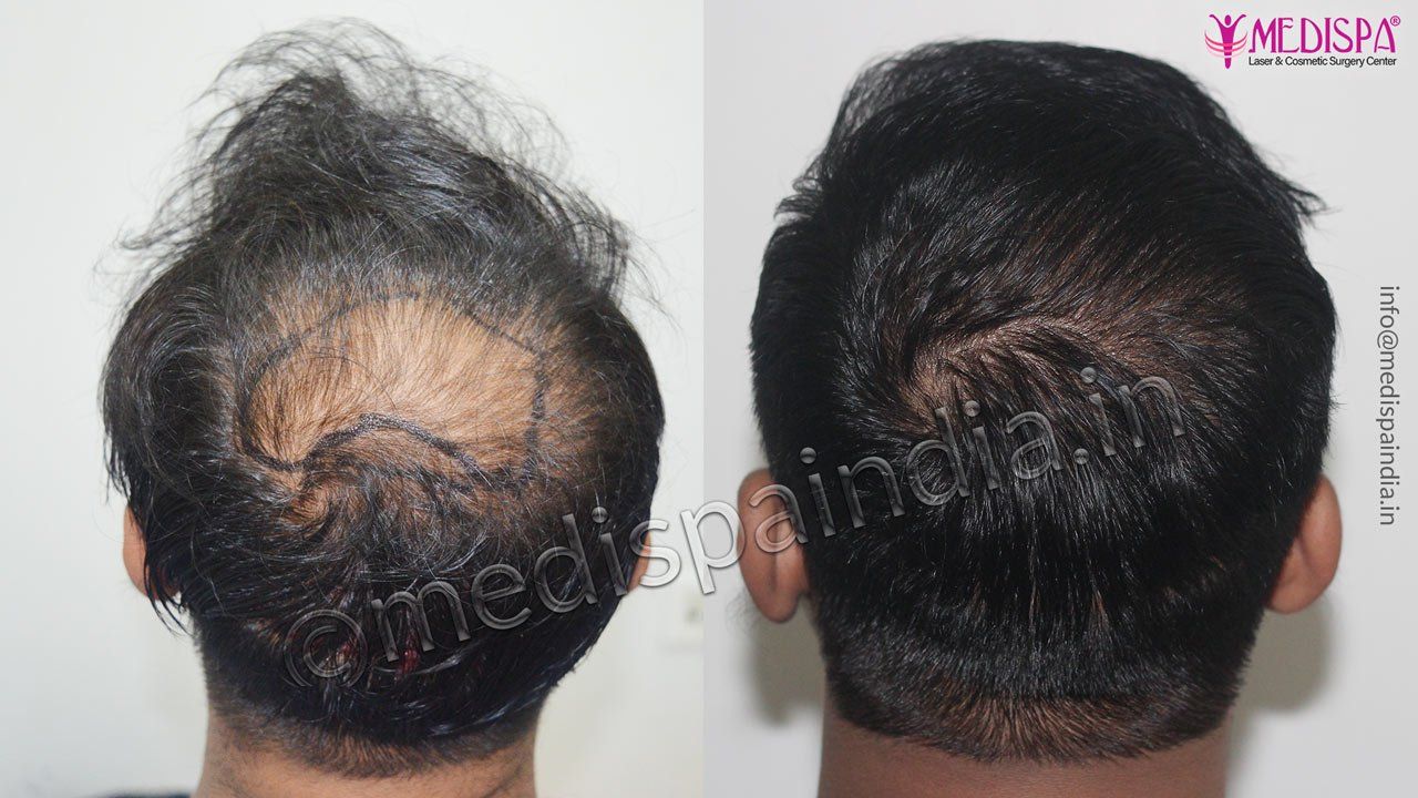 bad hair transplant replair delhi