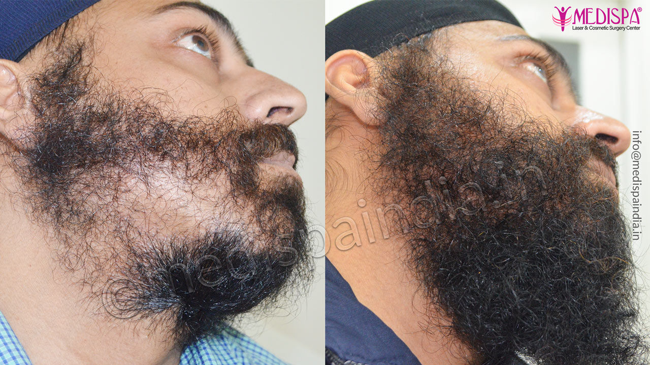 beard hair transplant india