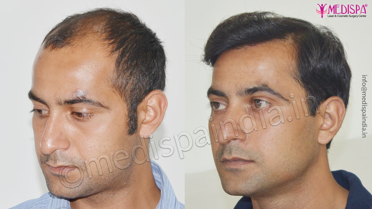 best hair transplant clinics in india