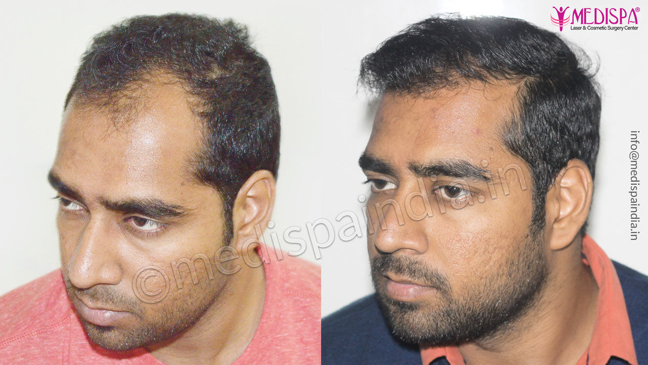 best hair transplant clinics in india