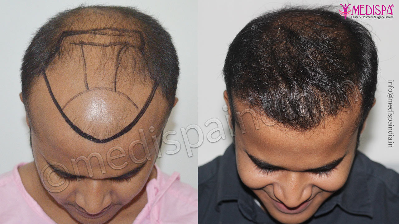 best hair transplant in usa