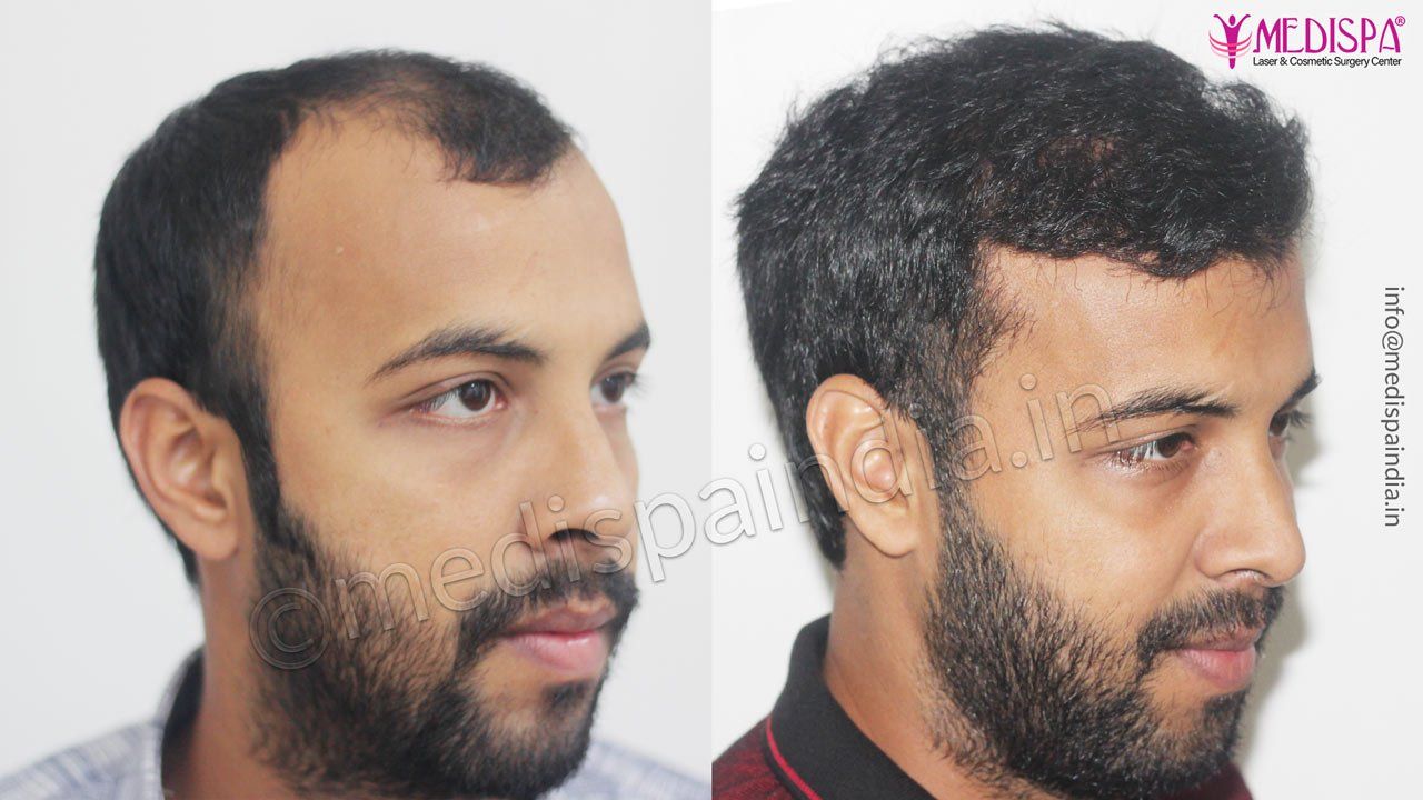 best hair transplant results delhi india