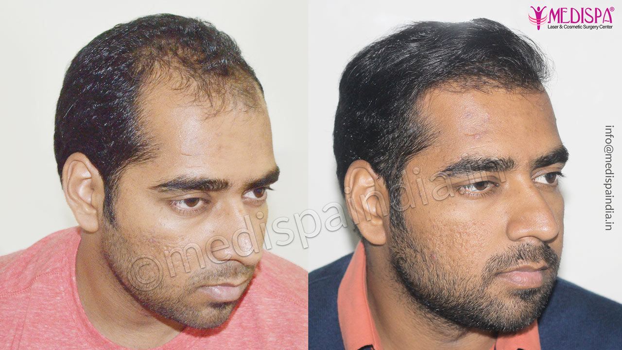 Male Hair Transplant Result After 10 Months | Medispa India