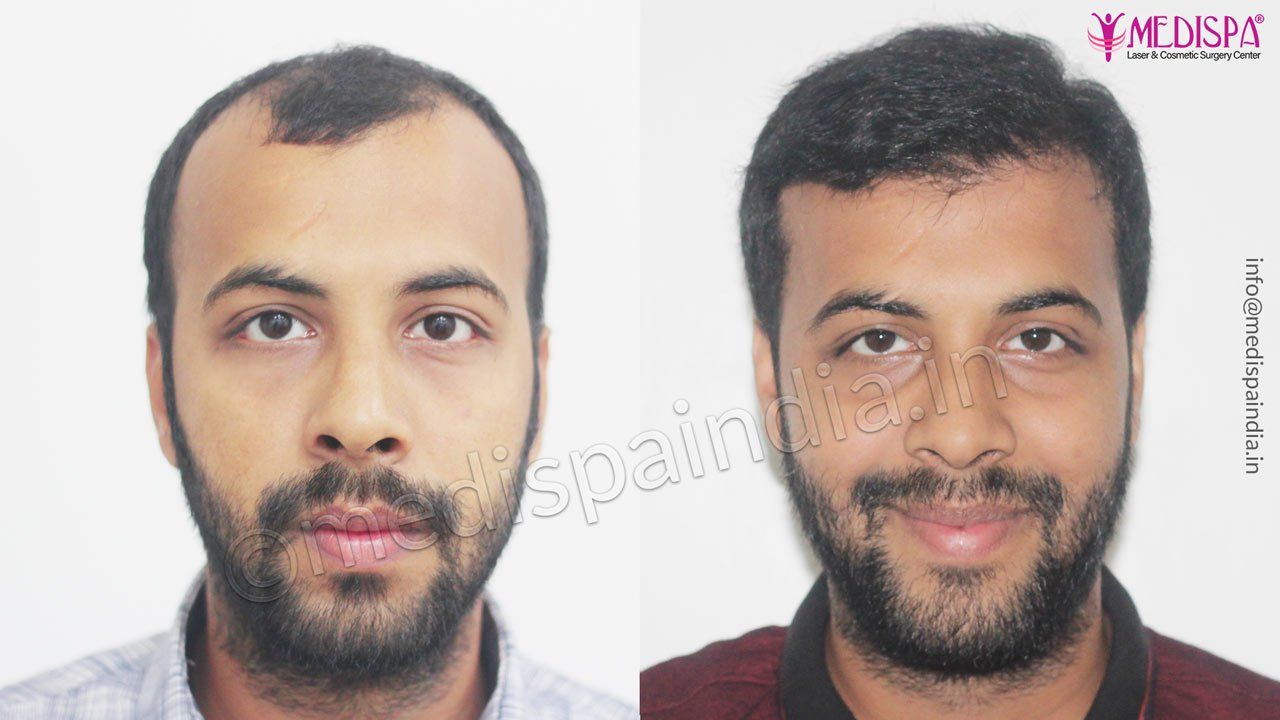 best hair transplant results Hyderabad