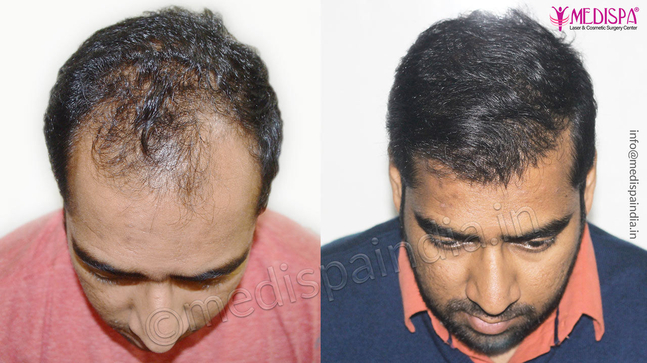 best hair transplant surgeons delhi india