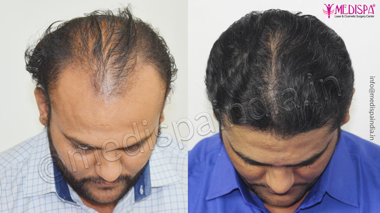 celebrity hair transplant result 