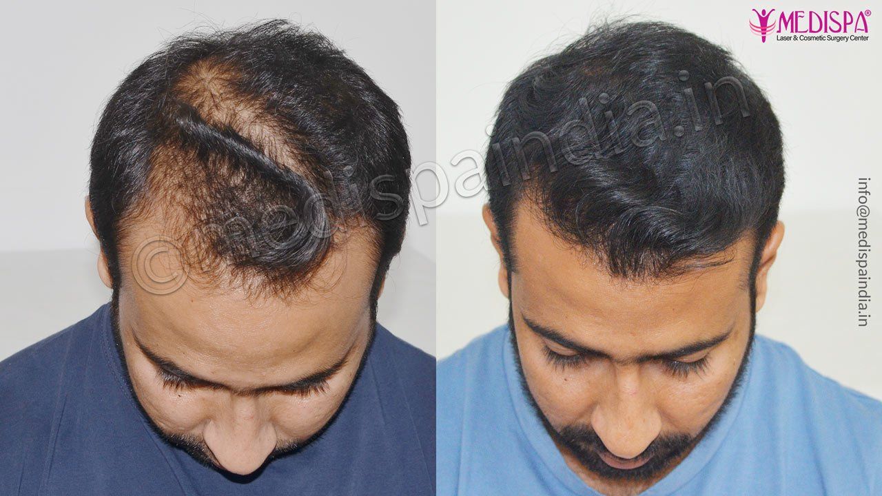 best hair transplant surgeons in hyderabad