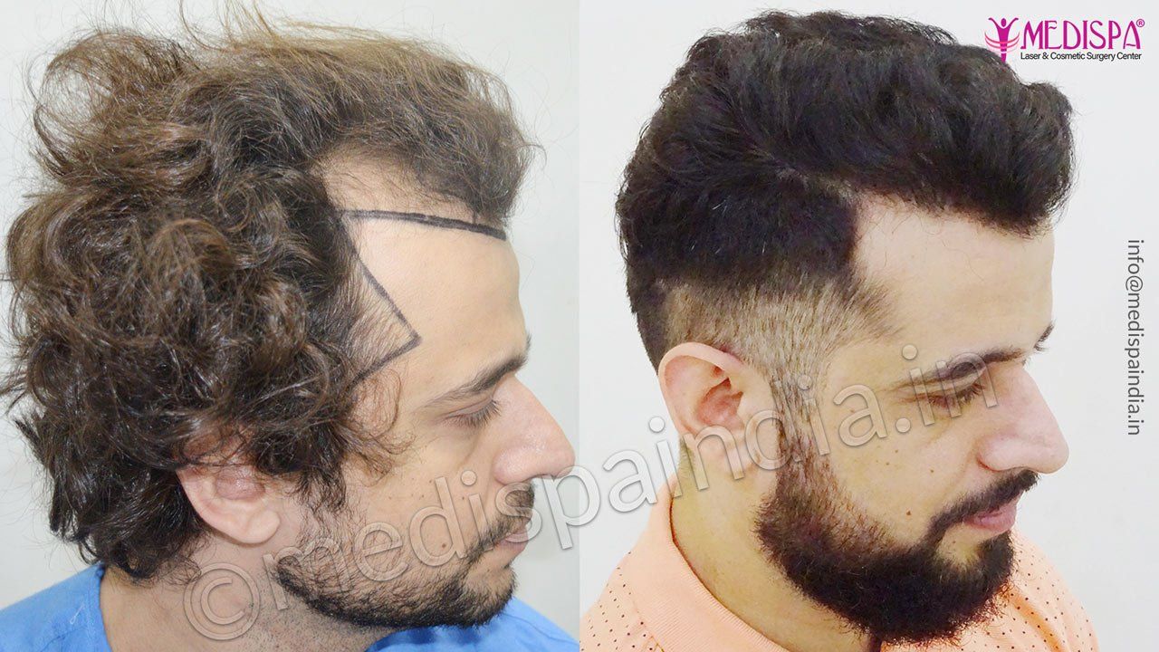 best hair transplant surgeons in usa