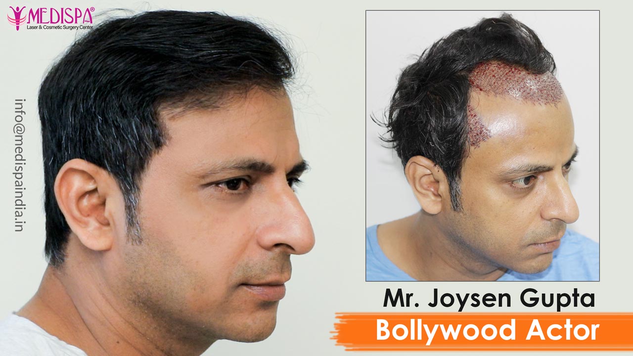 bollywood actor joysen gupta hair transplant jaipur