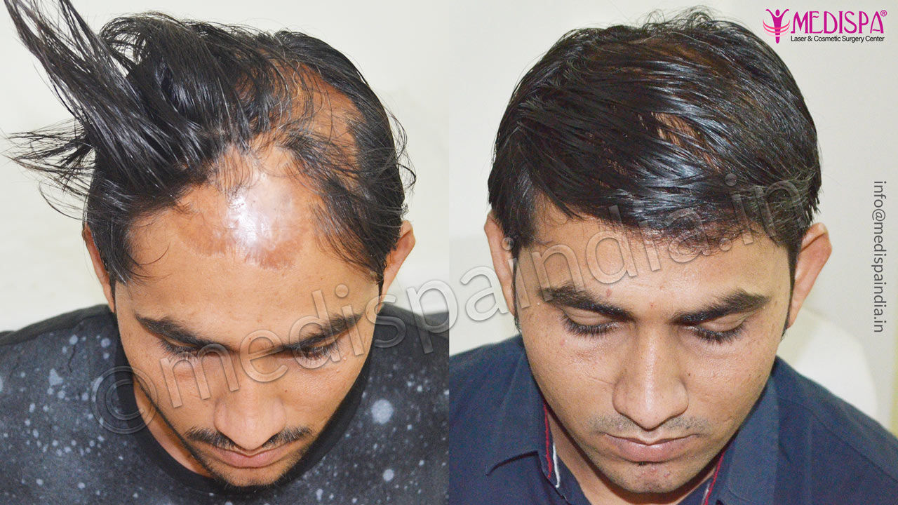 Burn Scar Hair Transplant Surgery Jaipur Top Hair Transplant Center Delhi Jaipur Hair 8551