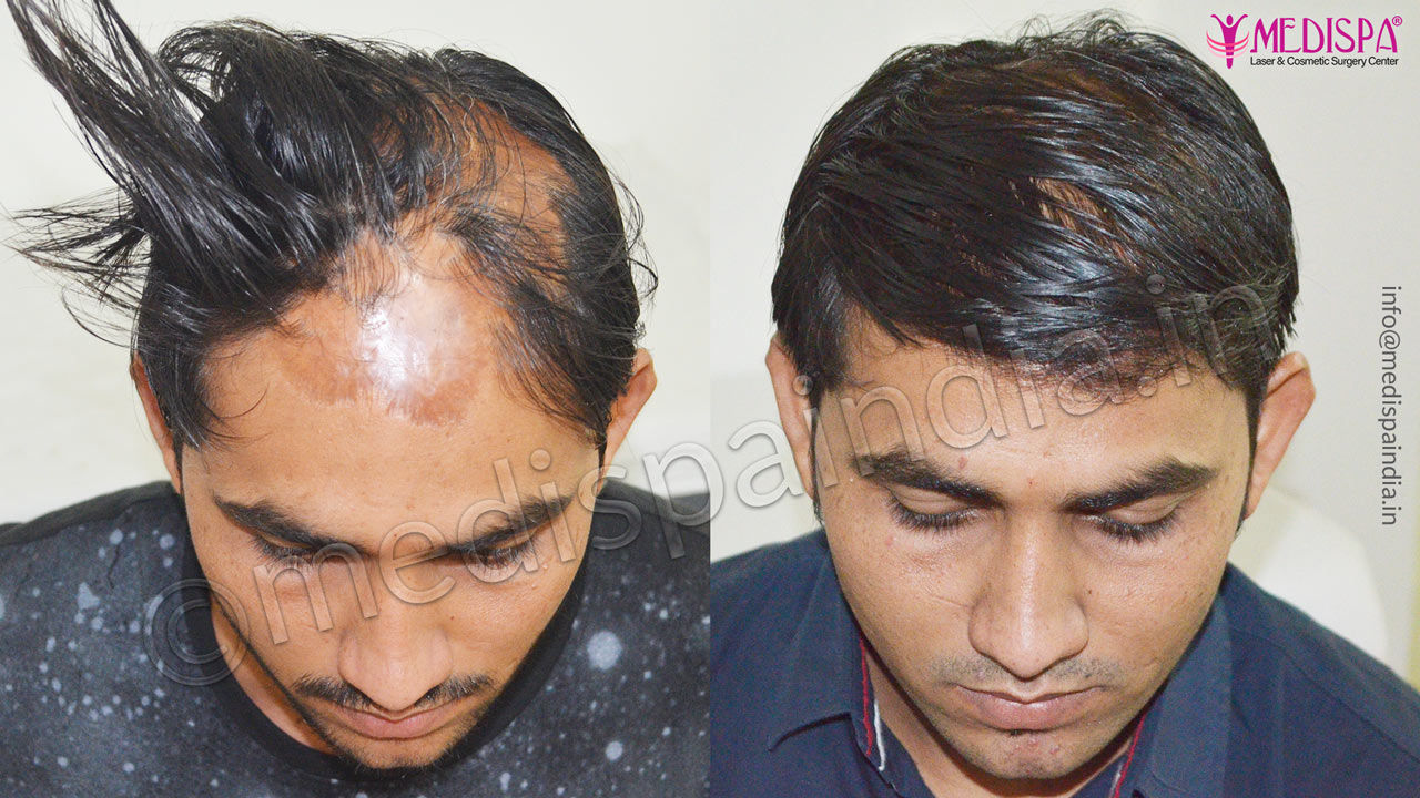 burn hair transplant correction medispa