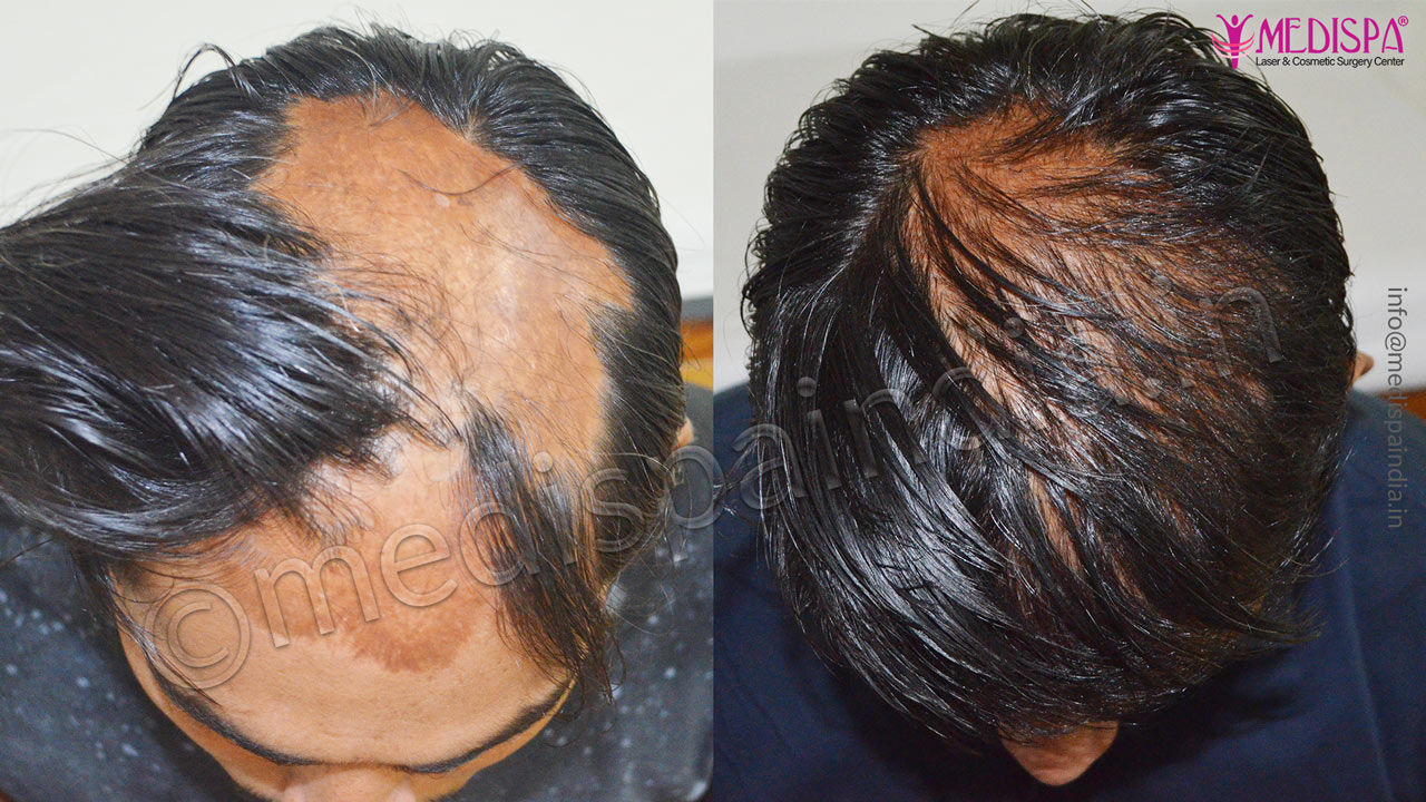 Burn Scar Hair Transplant Surgery Jaipur Top Hair Transplant Center Delhi Jaipur Hair 3948