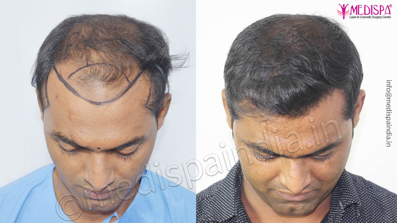 combination fut fue hair transplant india