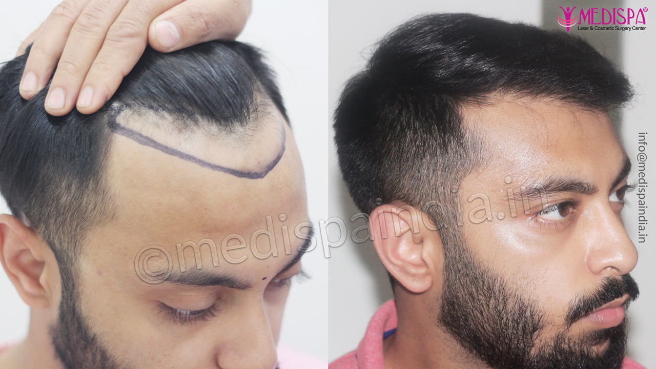 cost of hair transplant delhi