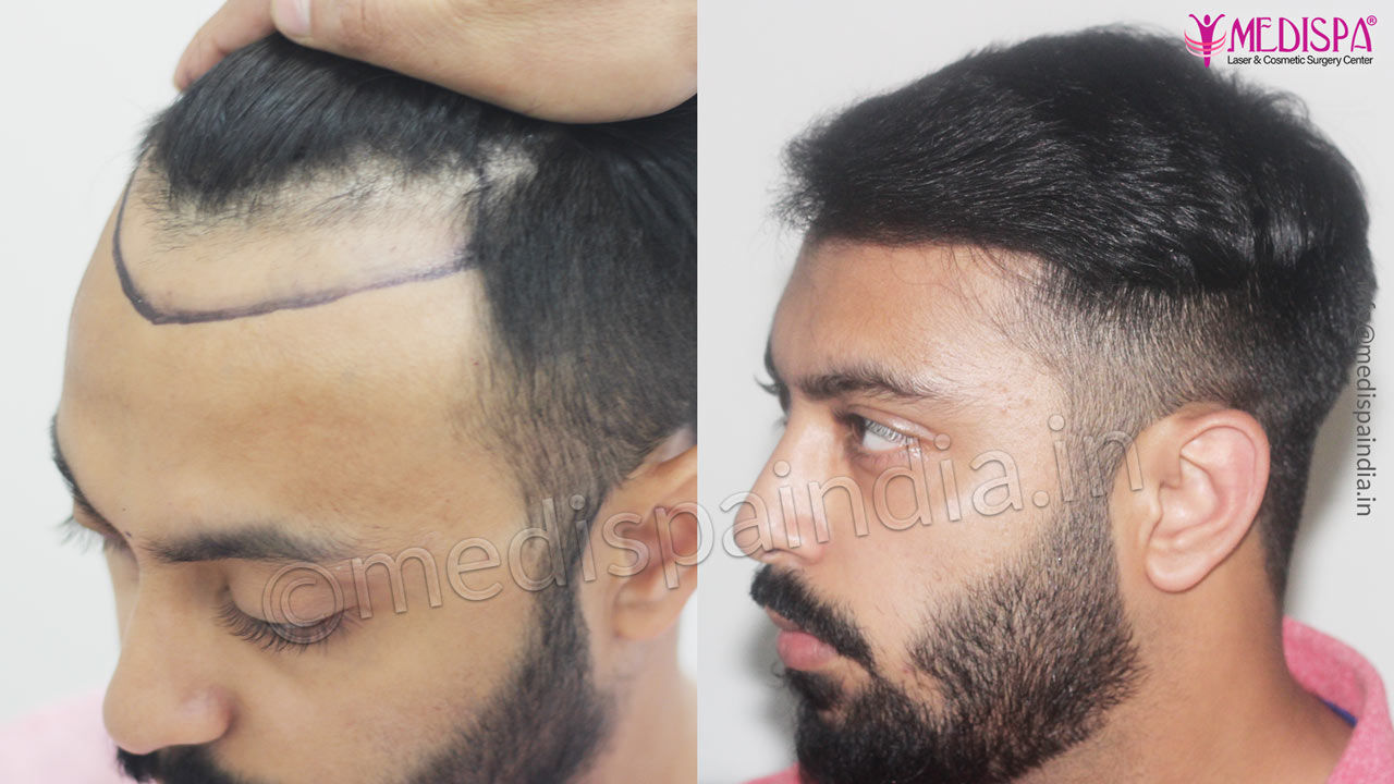 cost of hair transplant jaipur