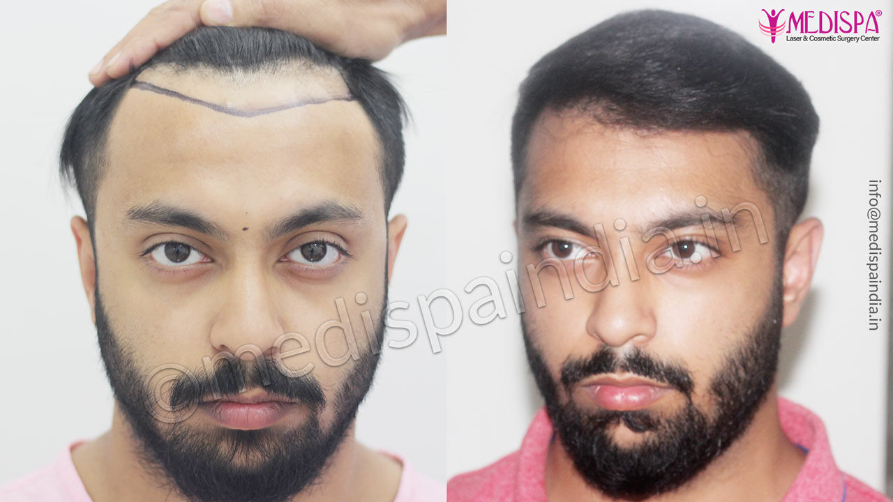 cost of hair transplant