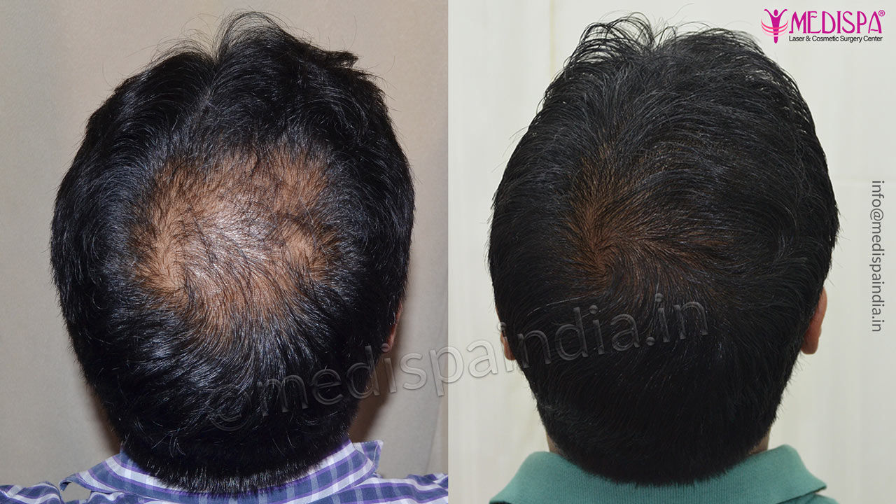 crown hair transplant results