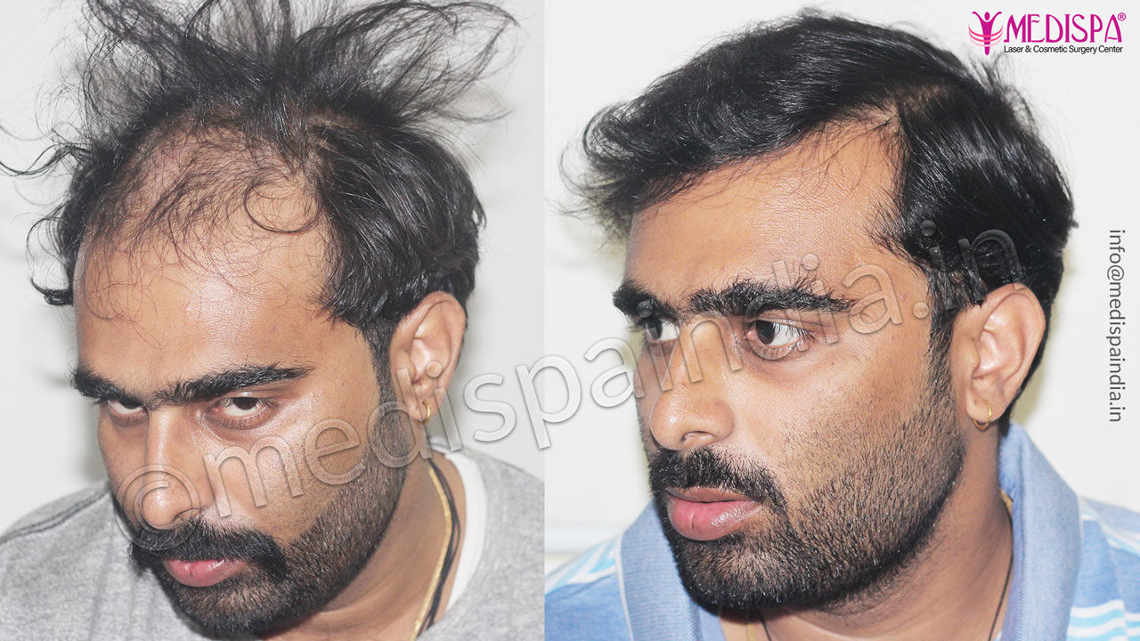 fue hair transplant delhi india