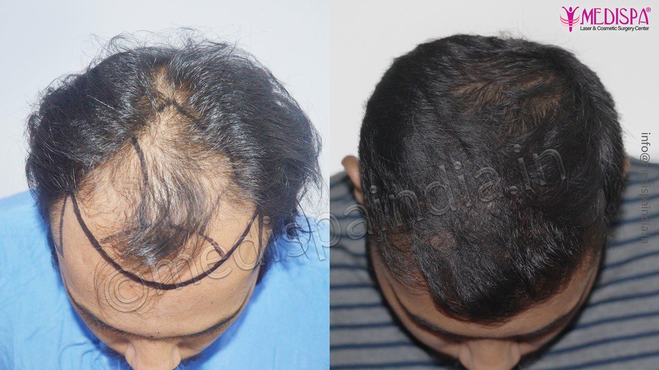 fue hair transplant india