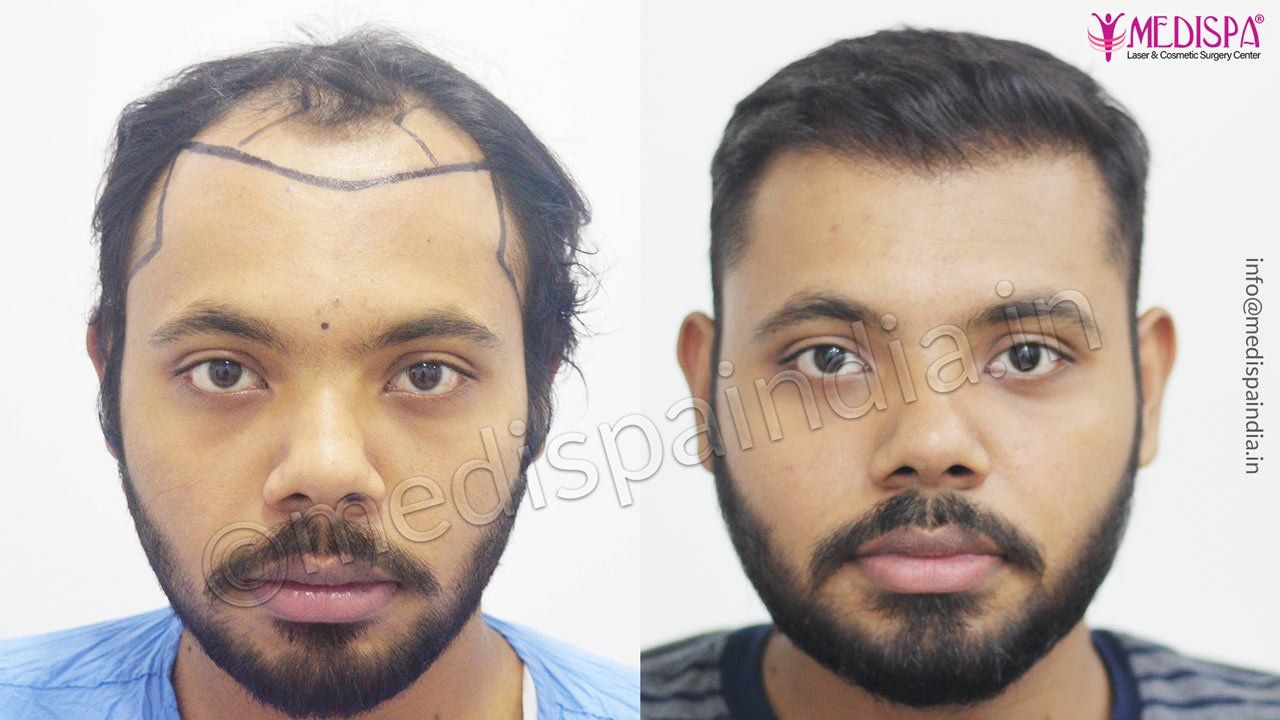 fue hair transplant results