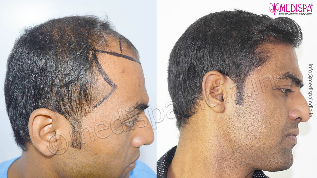 fut fue hair transplant delhi india