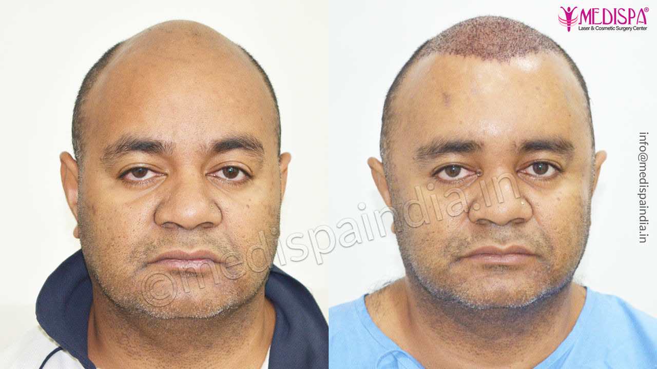 hair transplant in Australia