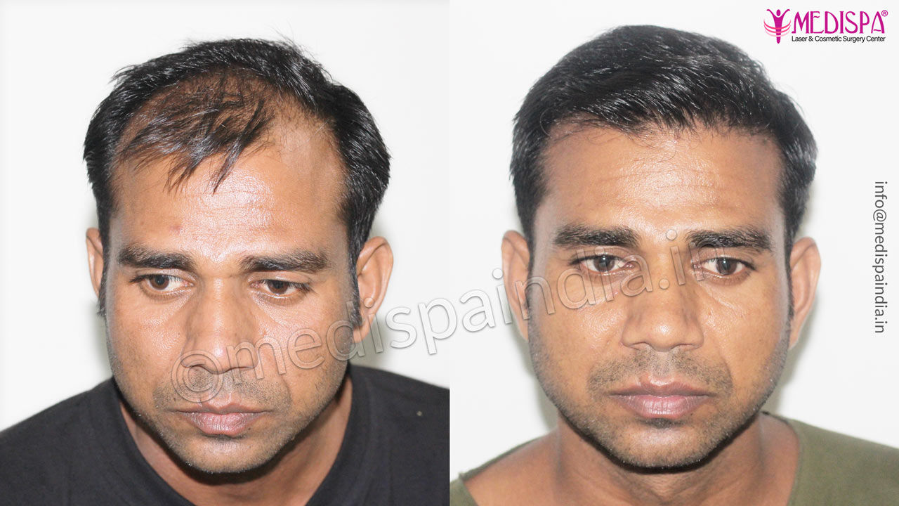 celebrity hair transplant result 