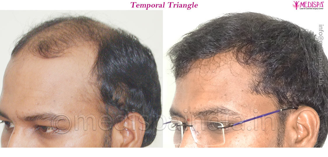 hair restoration cost bangalore