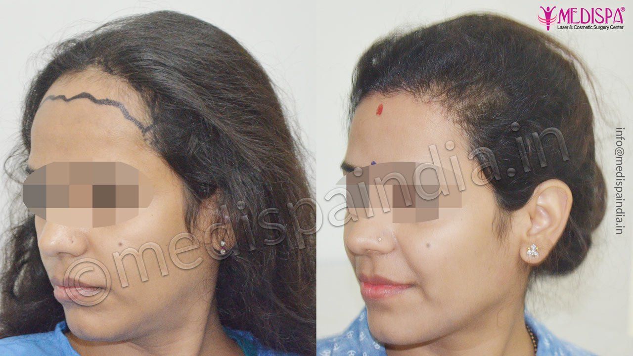 hair transplant in delhi, new delhi