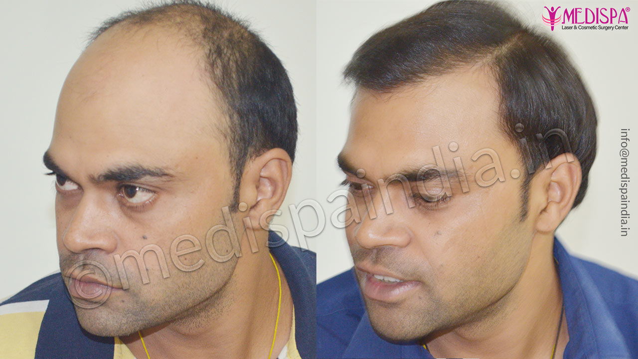 hair restoration cost in jaipur rajasthan