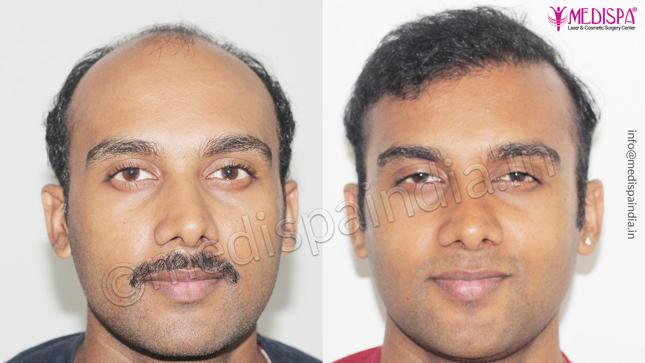 delhi hair transplant cost