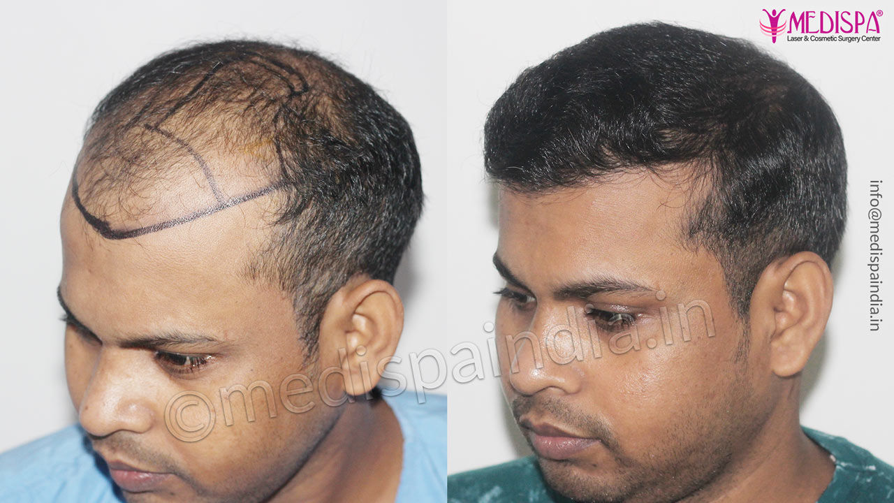 hair restoration delhi india