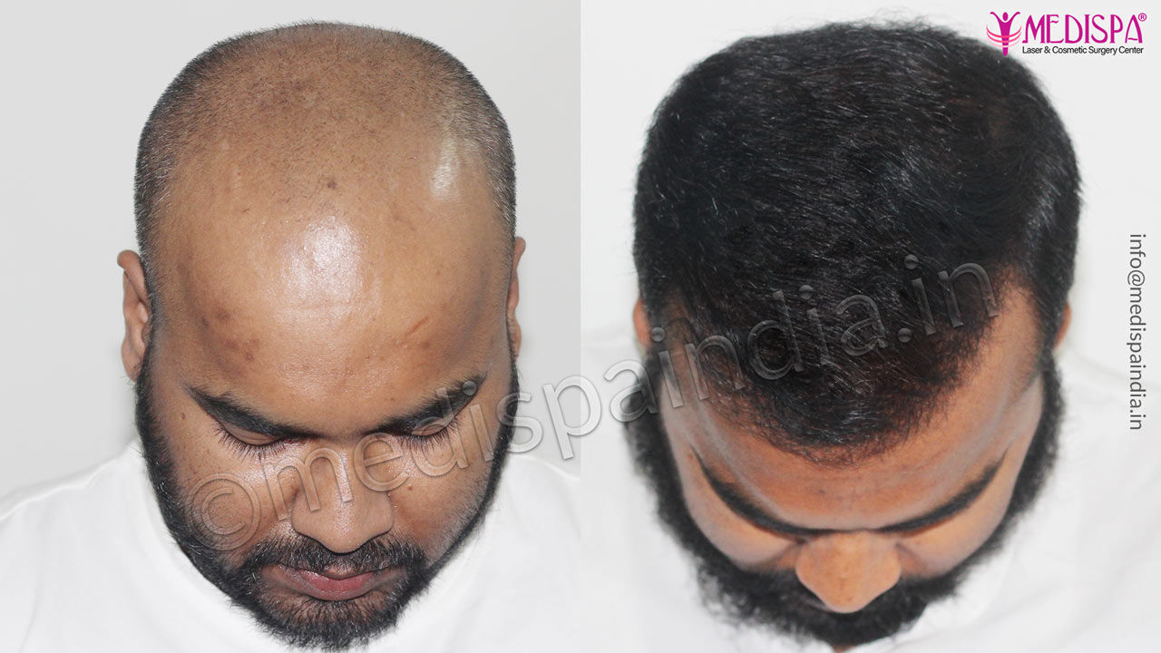 Norwood Class 7 hair transplant