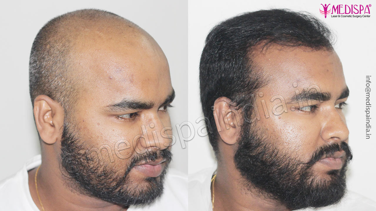 hair restoration results jaipur