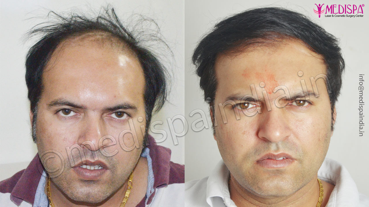 wrong hair transplant correction usa