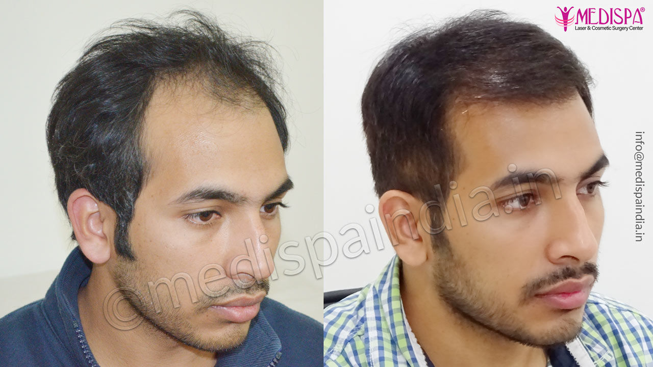 hair transplant ambala