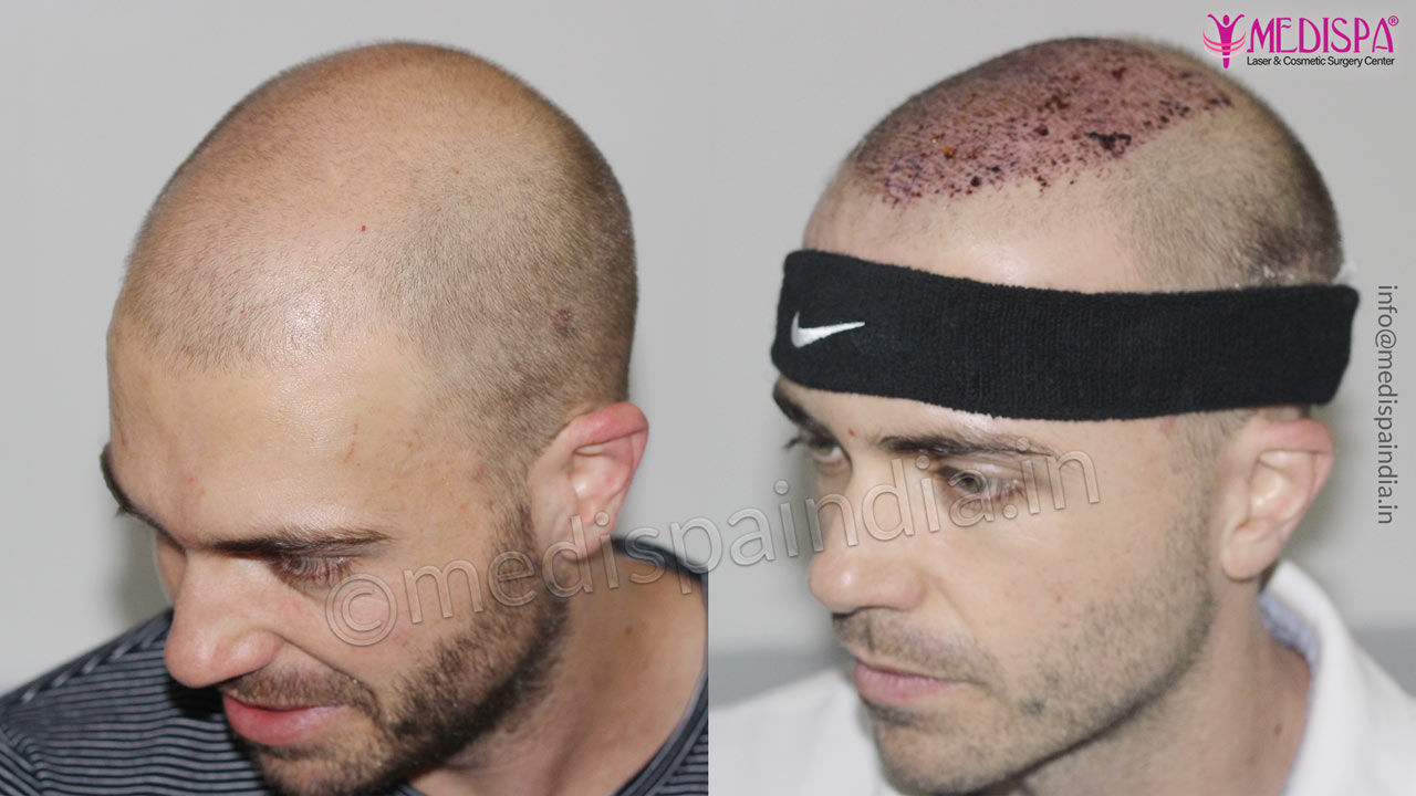 hair transplant before after asutralia