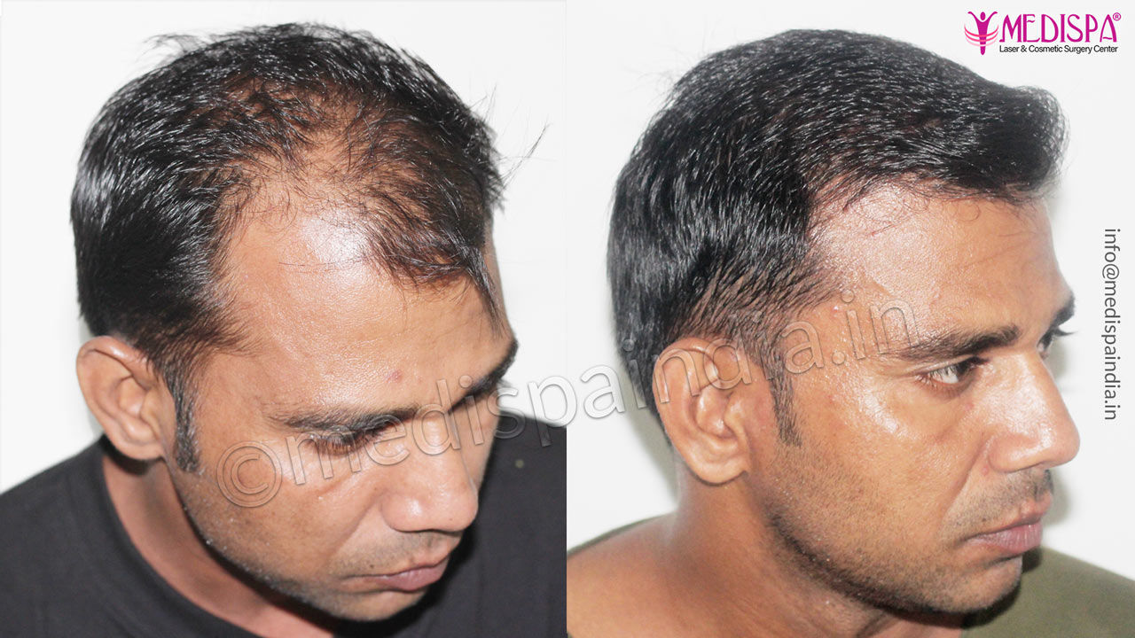 hair transplant before after result india