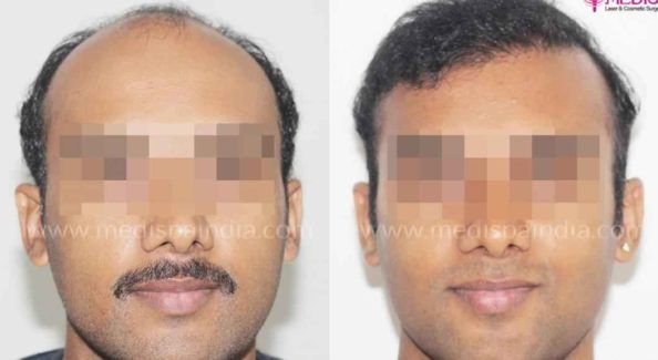 hair-transplant-before-after-results