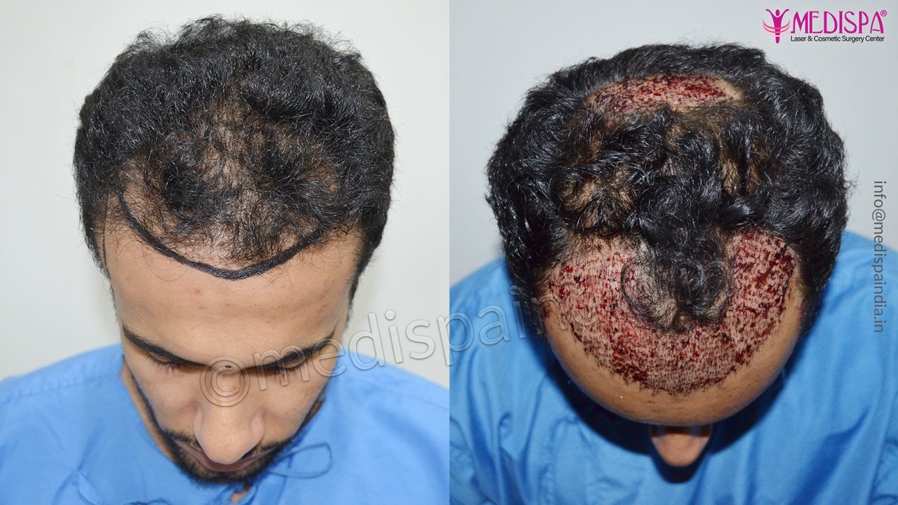 hair transplant before and after dubai